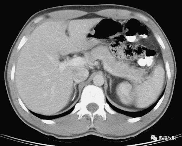 打卡学习：上腹部CT基础读片36张，看完就会了