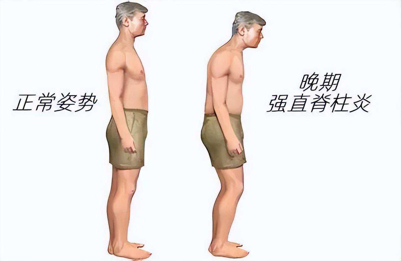 依那西普（恩利）--治疗强直性脊柱炎和类风湿关节炎的“黑科技”